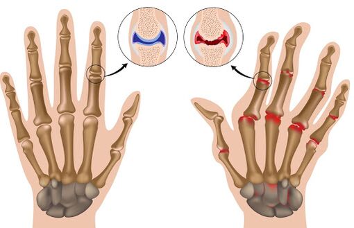 Penyakit arthritis dan manifestasinya