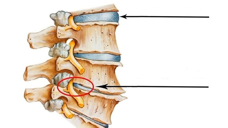 cedera tulang belakang dalam kasus osteochondrosis serviks