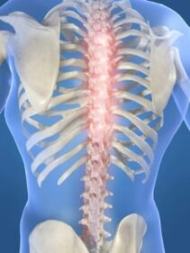 lesi tulang belakang dalam kasus osteochondrosis toraks