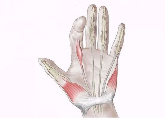 radang tendon sebagai penyebab nyeri pada persendian jari