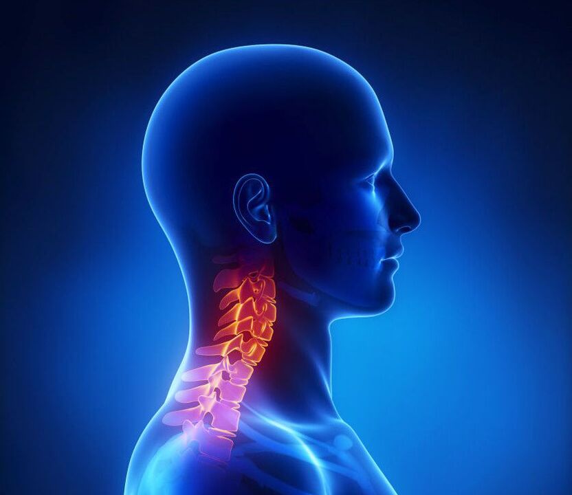 Osteochondrosis serviks adalah patologi tulang belakang, yang dapat Anda singkirkan di rumah