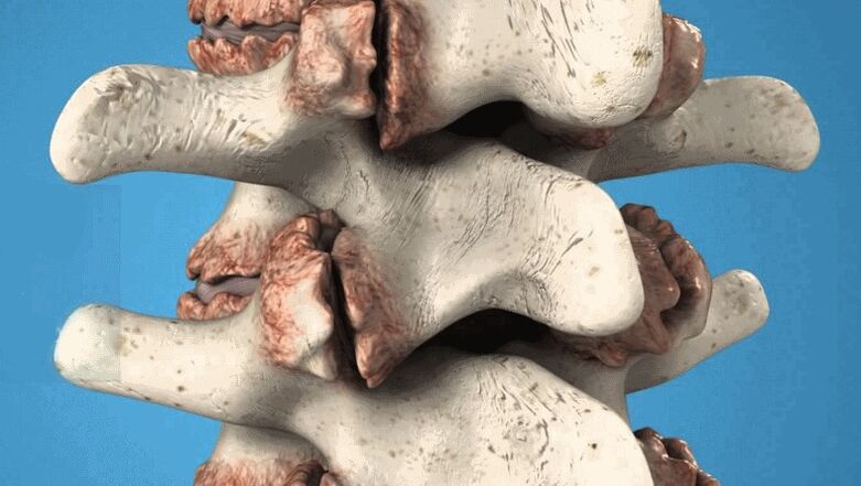 osteofit tulang belakang sebagai penyebab nyeri punggung bawah