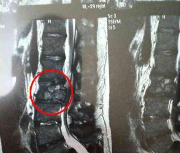 tumor tulang belakang sebagai penyebab sakit punggung