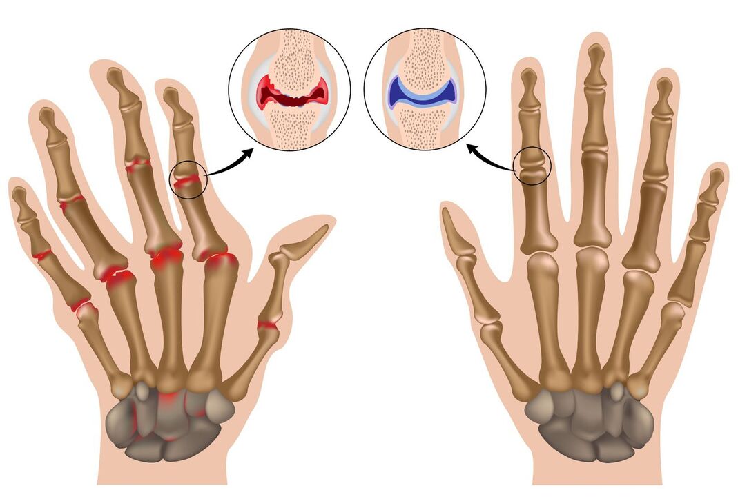 Sendi tangan yang sehat dan terkena poliartritis