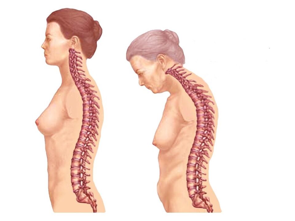 tulang belakang melengkung yang sehat dengan osteochondrosis