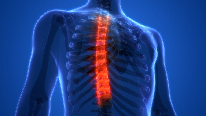 Osteochondrosis pada tulang belakang dada, ditandai dengan rusaknya cakram intervertebralis
