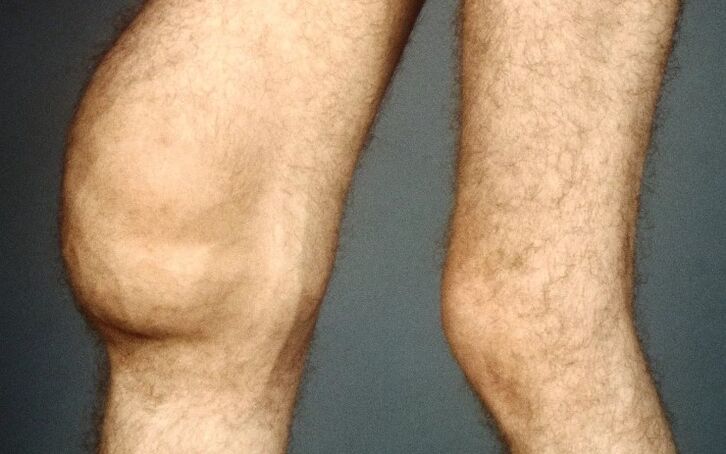 Arthrosis post -trauma dari sendi lutut