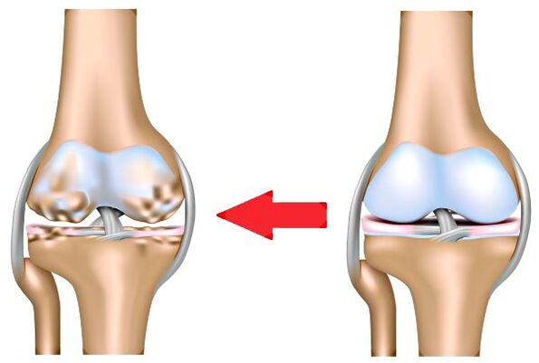 Sendi dan arthrosis yang sehat