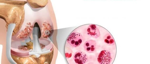 yang mengarah pada perkembangan arthrosis