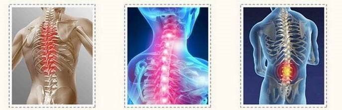 Lesi tulang belakang osteochondrosis