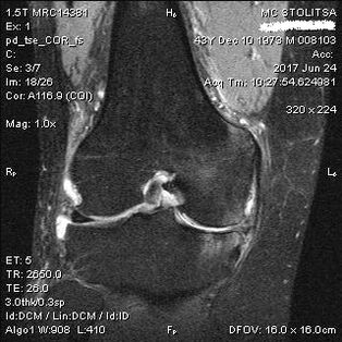Osteoartritis sendi lutut pada MRI