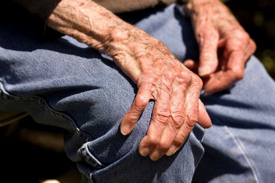 Arthrosis adalah penyakit terkait usia yang terjadi pada orang tua