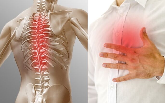 Osteochondrosis toraks dimanifestasikan oleh nyeri dan rasa sesak di dada